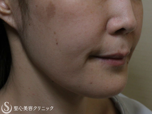 【40代女性・口元のたるみ】プレミアムミニリフト Before 