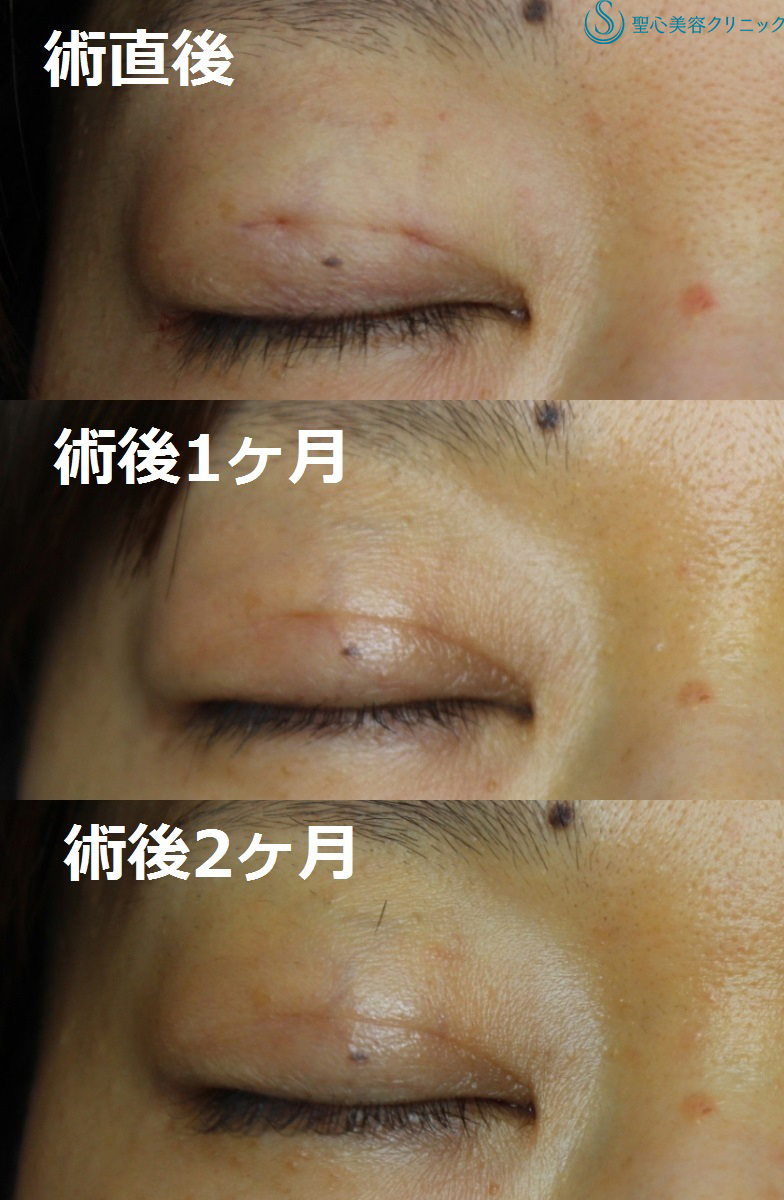 【40代女性・画期的な二重埋没法】マイクロメソッド＋α法（2か月後）（広島院） After 