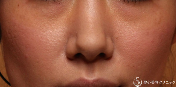 【30代 女性・クマと法令線の改善】プレミアムPRP皮膚再生療法（11か月後） Before 