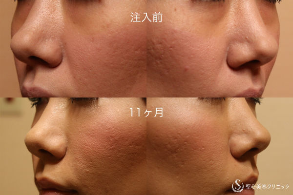【30代 女性・クマと法令線の改善】プレミアムPRP皮膚再生療法（11か月後） After 