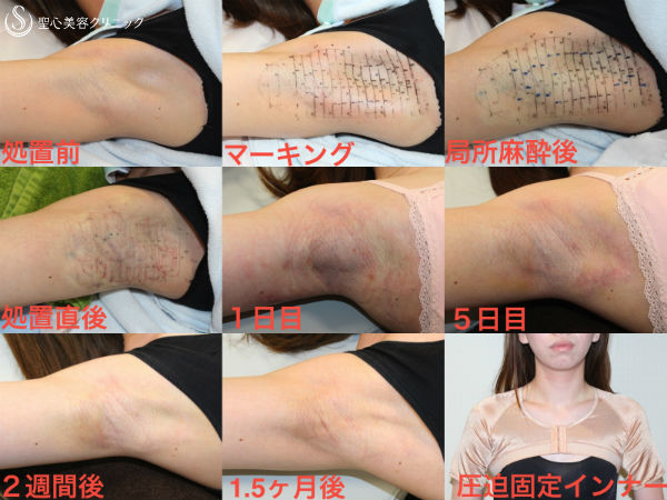 【20代女性】わきが・多汗治療　ミラドライ（経過） After 