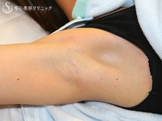 【20代女性】わきが・多汗治療　ミラドライ（経過） Before 