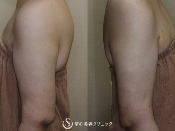 【20代女性　二の腕のたるみ取り】脂肪吸引＋皮膚切除 After 