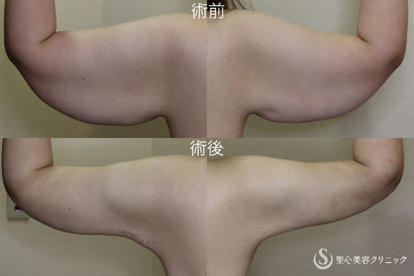 【20代女性　二の腕のたるみ取り】脂肪吸引＋皮膚切除 After 