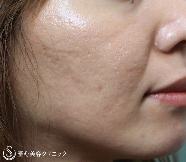 【女性・ニキビ跡】イントラセル　ニキビ跡とスキンケア After 