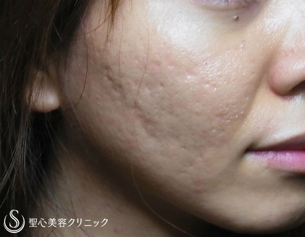【女性・ニキビ跡】イントラセル　ニキビ跡とスキンケア Before 