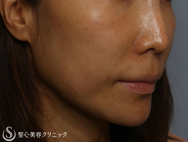 40代女性 頬のコケ改善 頬 目の下プレミアムprp 症例写真 美容整形 美容外科なら聖心美容クリニック