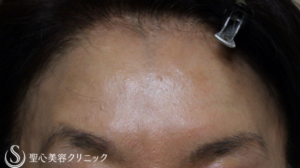 【60代女性・額の若返り】プレミアムPRP皮膚再生療法 After 
