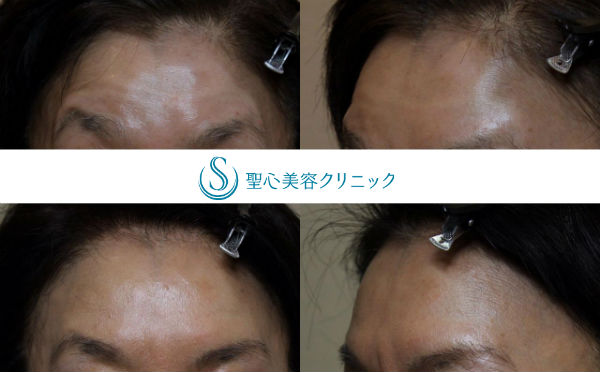 【60代女性・額の若返り】プレミアムPRP皮膚再生療法 After 