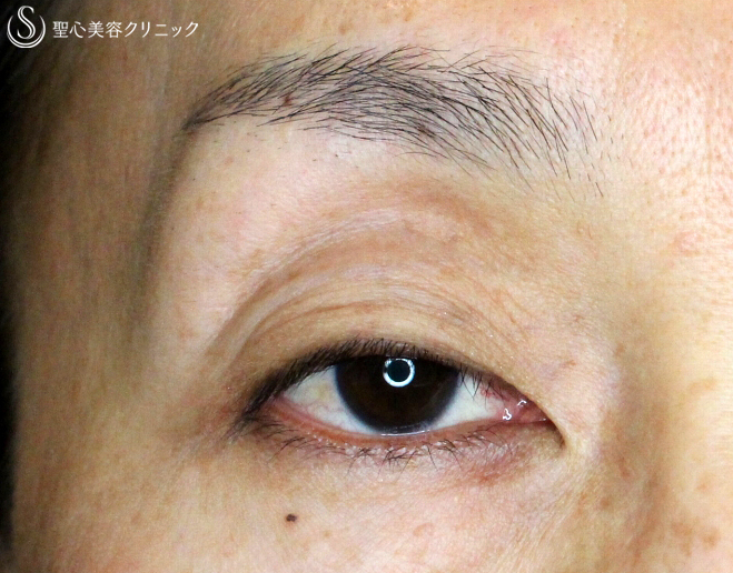 【40代女性・ハードコンタクトレンズ眼瞼下垂の長期経過】切らない眼瞼下垂+α法（9年後） Before 