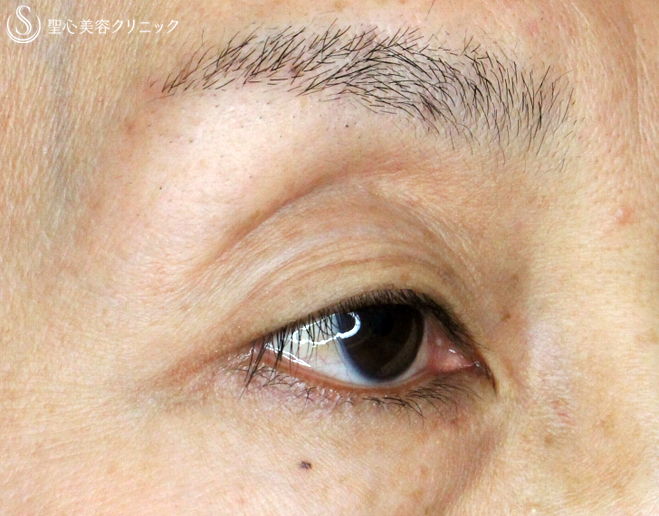 【40代女性・ハードコンタクトレンズ眼瞼下垂の長期経過】切らない眼瞼下垂+α法（9年後） Before 