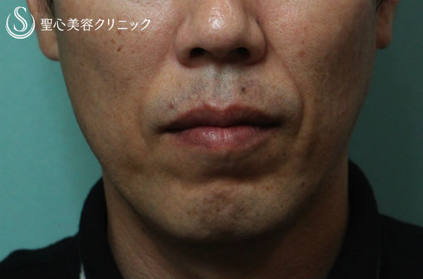 【40代男性・横顔を綺麗に】顎プロテーゼ Before 