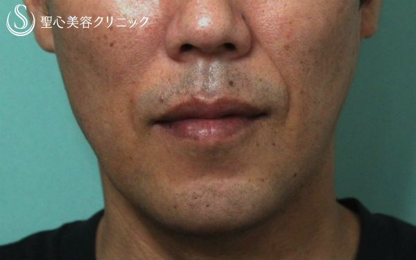 【40代男性・横顔を綺麗に】顎プロテーゼ After 