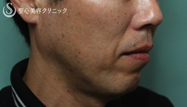 【40代男性・横顔を綺麗に】顎プロテーゼ Before 