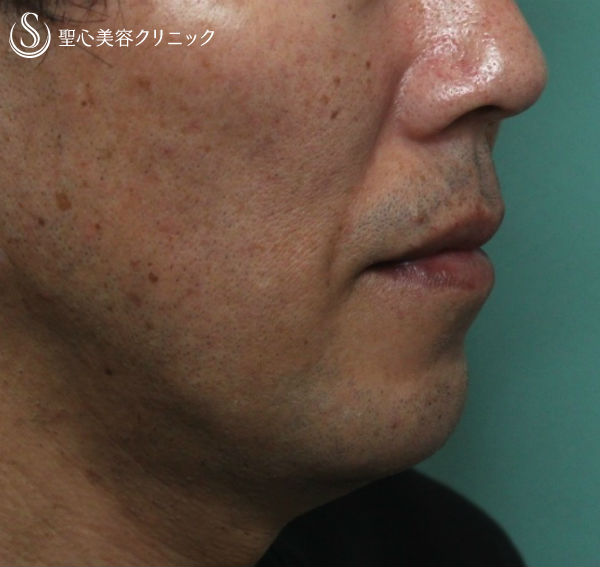 【40代男性・横顔を綺麗に】顎プロテーゼ After 
