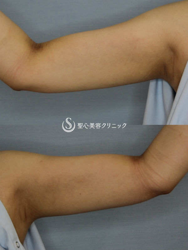 【20代女性・二の腕の脂肪吸引】ベイザーリポ2.2脂肪吸引（3ヶ月後） After 