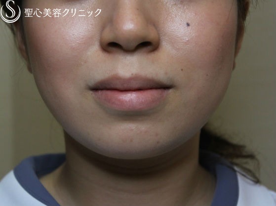 【20代 女性　顎をすっきり小顔に】顎ヒアルロン酸注入 Before 