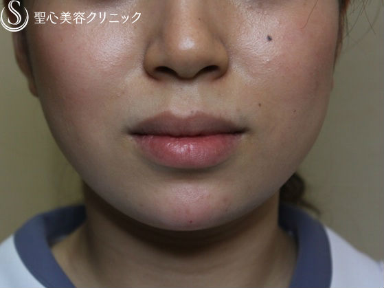 【20代 女性　顎をすっきり小顔に】顎ヒアルロン酸注入 After 