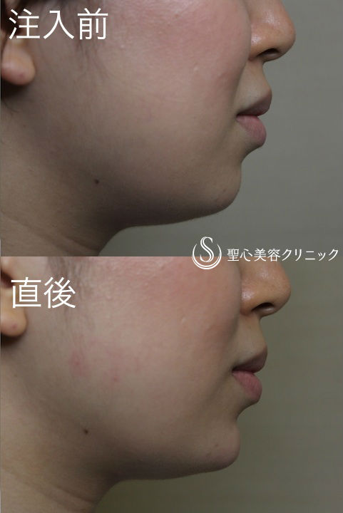 【20代 女性　顎をすっきり小顔に】顎ヒアルロン酸注入 After 