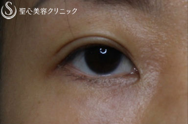 【30代 女性・二重】全切開 After 