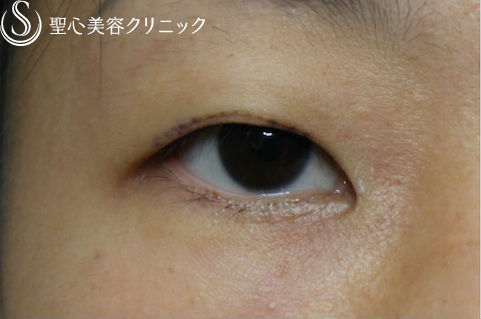 【30代 女性・二重】全切開 Before 