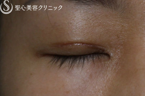 【30代 女性・二重】全切開 After 