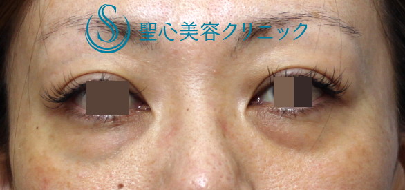【30代女性・目の下のクマ（膨らみ）】　目の下の脂肪除去 Before 