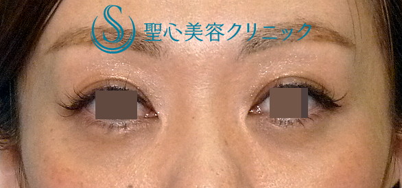 【30代女性・目の下のクマ（膨らみ）】　目の下の脂肪除去 After 