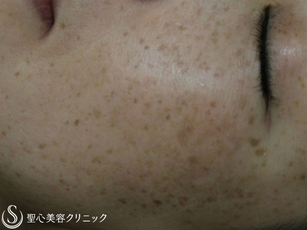 【50代女性・しみ/小じわ】Nトレチノイン＋ハイドロキノン（4ヶ月後） After 