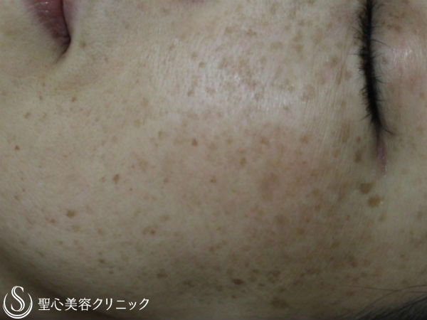 【50代女性・しみ/小じわ】Nトレチノイン＋ハイドロキノン（4ヶ月後） Before 