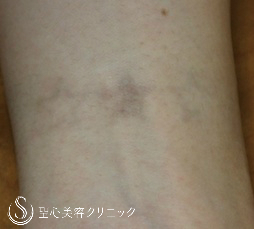 【20代女性・タトゥー(刺青)除去】Qスイッチレーザー After 