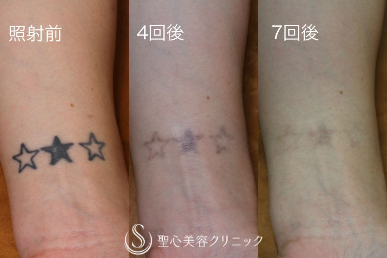 【20代女性・タトゥー(刺青)除去】Qスイッチレーザー After 