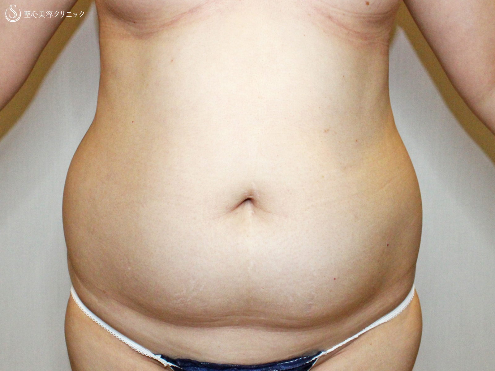 50代女性 腹部全周 14cm ベイザー脂肪吸引 1ヶ月後 症例写真 美容整形 美容外科なら聖心美容クリニック