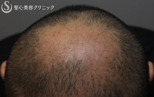 【毛髪再生】脂肪由来幹細胞による毛髪再生：セリューション Before 