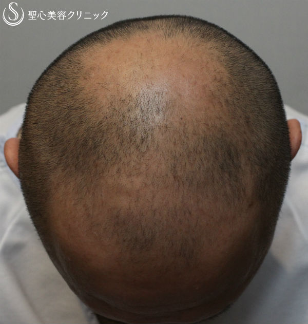 【毛髪再生】脂肪由来幹細胞による毛髪再生：セリューション Before 