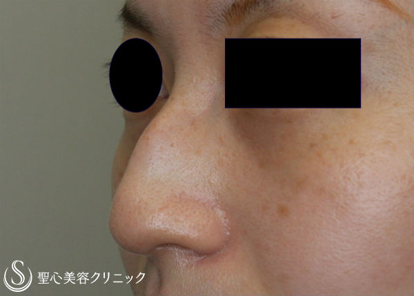 【30代女性・鈎鼻（ワシ鼻）の改善】鼻骨削り＋シリコンプロテーゼ挿入（1ヶ月） Before 