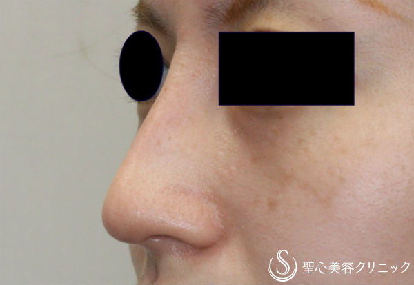 【30代女性・鈎鼻（ワシ鼻）の改善】鼻骨削り＋シリコンプロテーゼ挿入（1ヶ月） After 