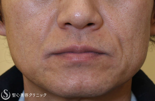 【40代男性・ほうれい線の若返り】プレミアムPRP皮膚再生療法（1年8ヶ月後） Before 