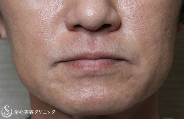 【40代男性・ほうれい線の若返り】プレミアムPRP皮膚再生療法（1年8ヶ月後） After 