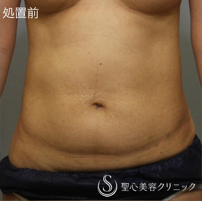 【40代 女性・切らない痩身】キャビテーションシェイプ（6回コース後） Before 