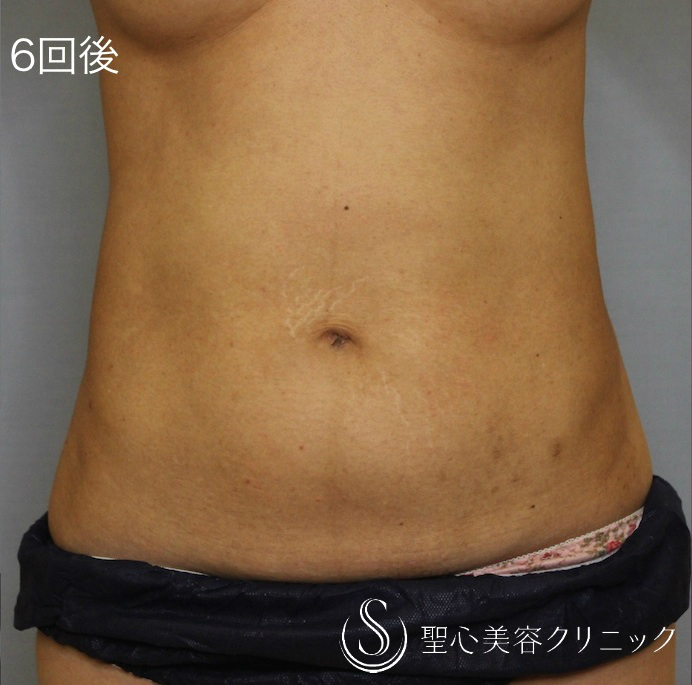 【40代 女性・切らない痩身】キャビテーションシェイプ（6回コース後） After 