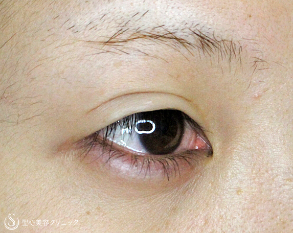 【20代女性・他院全切開後の修正】眼瞼下垂手術を応用した全切開法（8年後） Before 