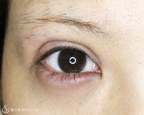 【20代女性・他院全切開後の修正】眼瞼下垂手術を応用した全切開法（8年後） Before 