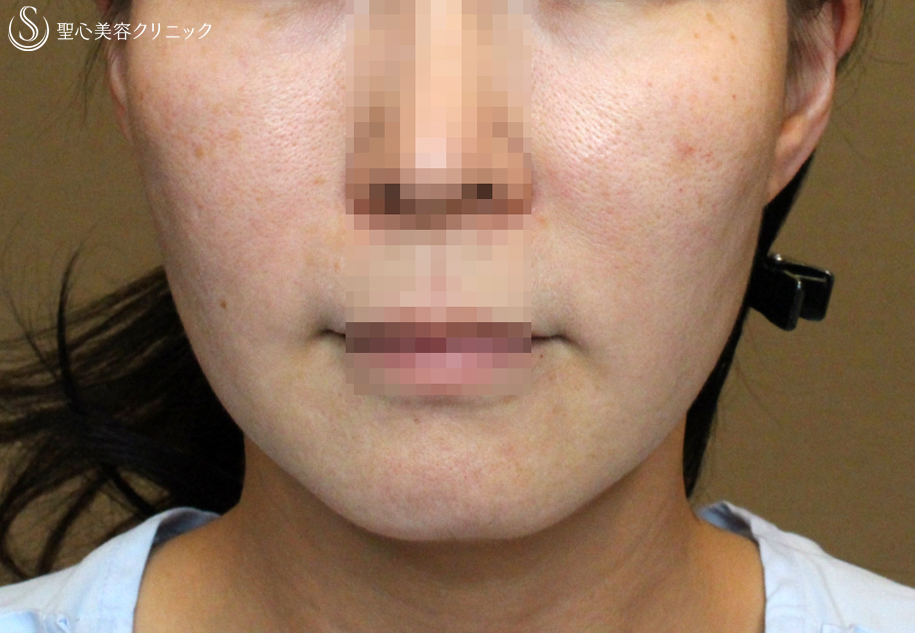 【40代女性・糸のリフトアップ】スプリングスレッドリフト（1ヶ月後） Before 