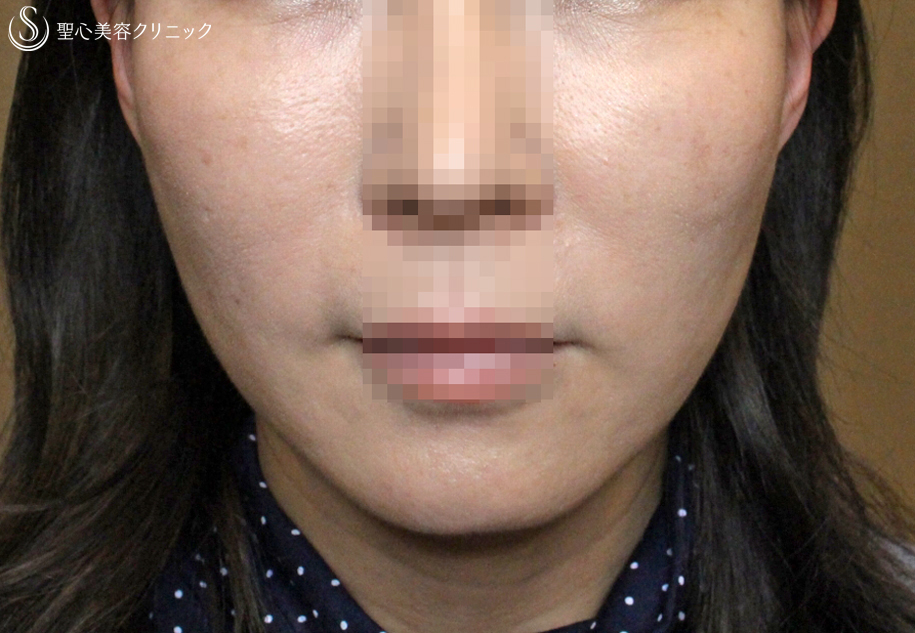 【40代女性・糸のリフトアップ】スプリングスレッドリフト（1ヶ月後） After 