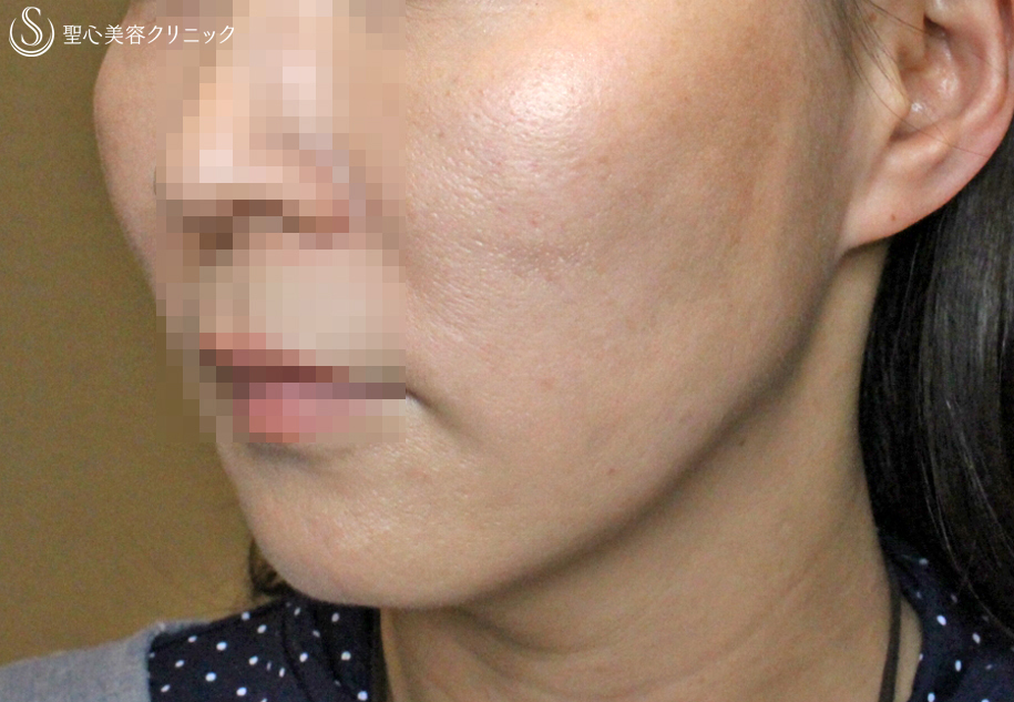 【40代女性・糸のリフトアップ】スプリングスレッドリフト（1ヶ月後） After 