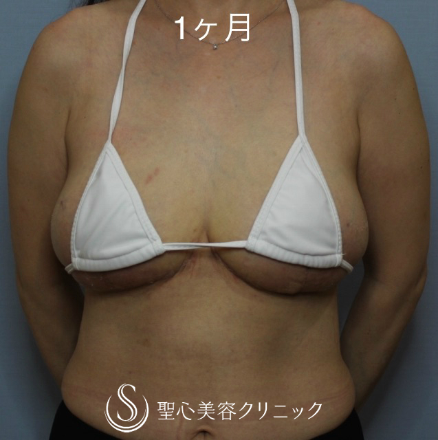 【40代女性・垂れている乳房を縮小したい】乳房縮小術（Pitanguy法）（1ヶ月後） After 
