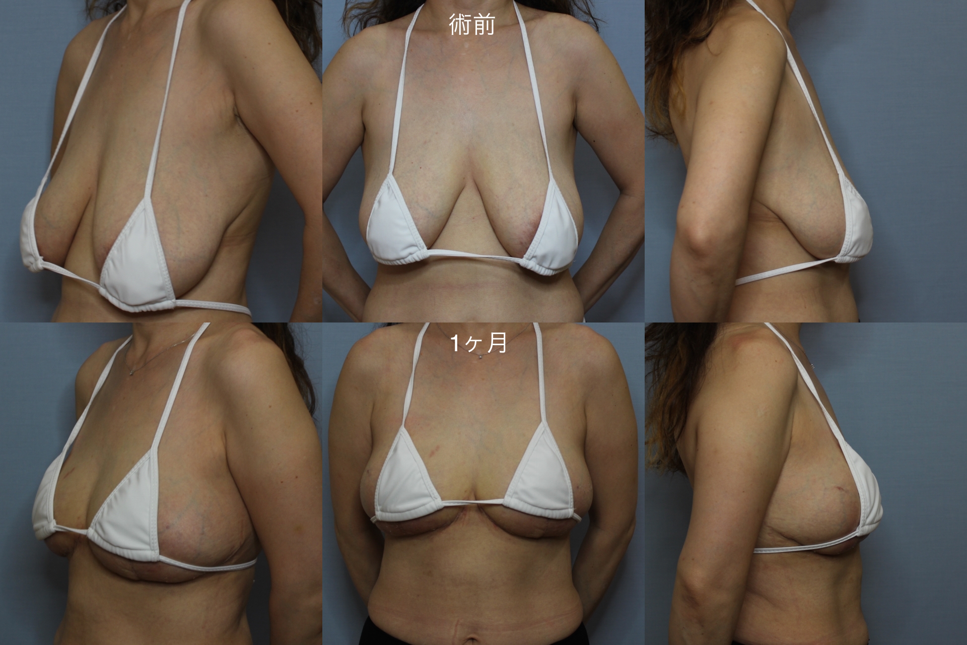 【40代女性・垂れている乳房を縮小したい】乳房縮小術（Pitanguy法）（1ヶ月後） After 