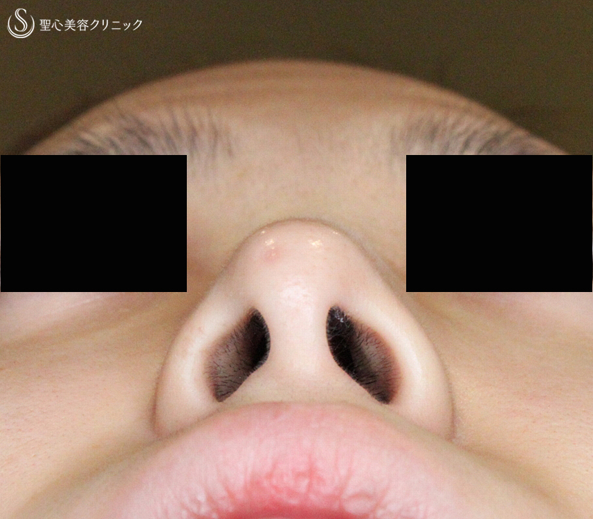 【20代女性・再手術の症例】小鼻縮小術+α法（1年後）札幌院 Before 