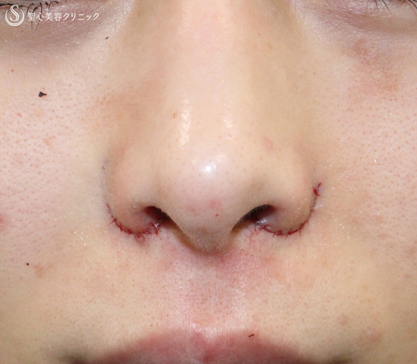 【20代女性・再手術の症例】小鼻縮小術+α法（1年後）札幌院 Before 